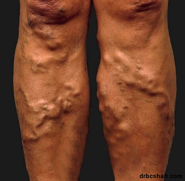 varices jambes homme